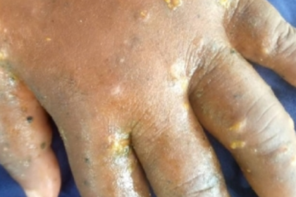 Skin disease outbreak leaves Mepe-Avetakpo residents in agony