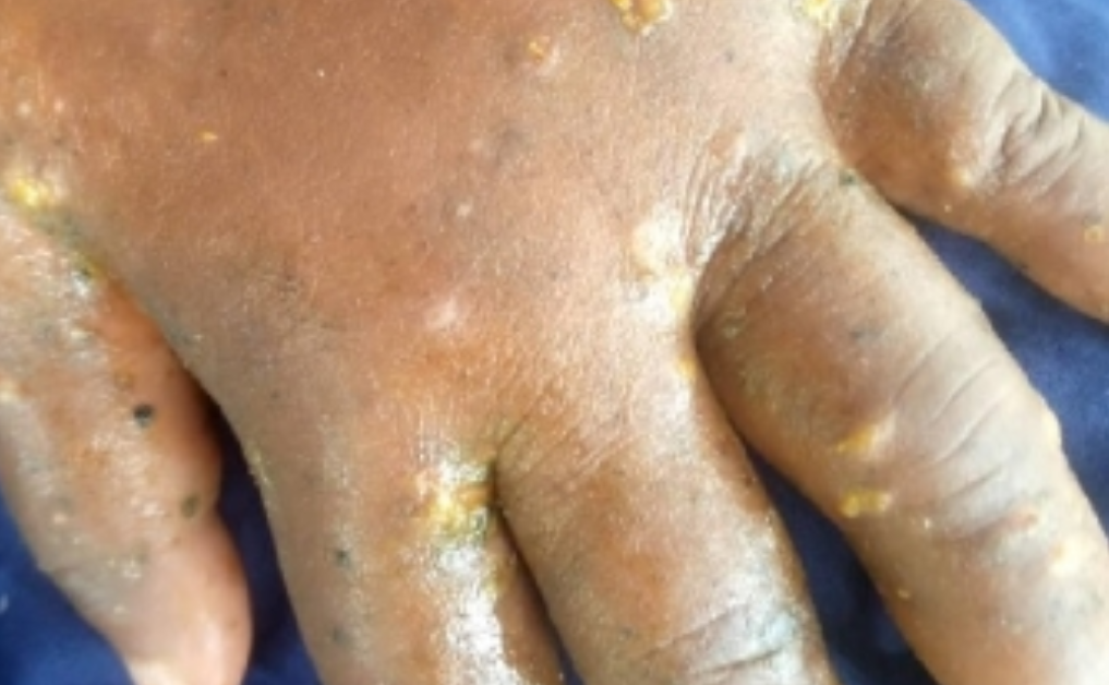Skin disease outbreak leaves Mepe-Avetakpo residents in agony